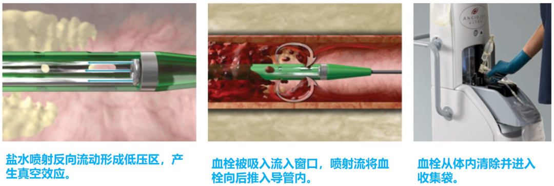 医学上ipc是什么米国静脉论坛上肢深静脉血栓临床指南与深度解析_https://www.jmylbn.com_新闻资讯_第22张
