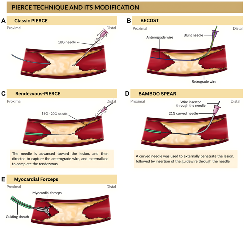 动脉钳怎么用动脉重度钙化导丝无法通过 针具技术超补救策略_https://www.jmylbn.com_新闻资讯_第9张