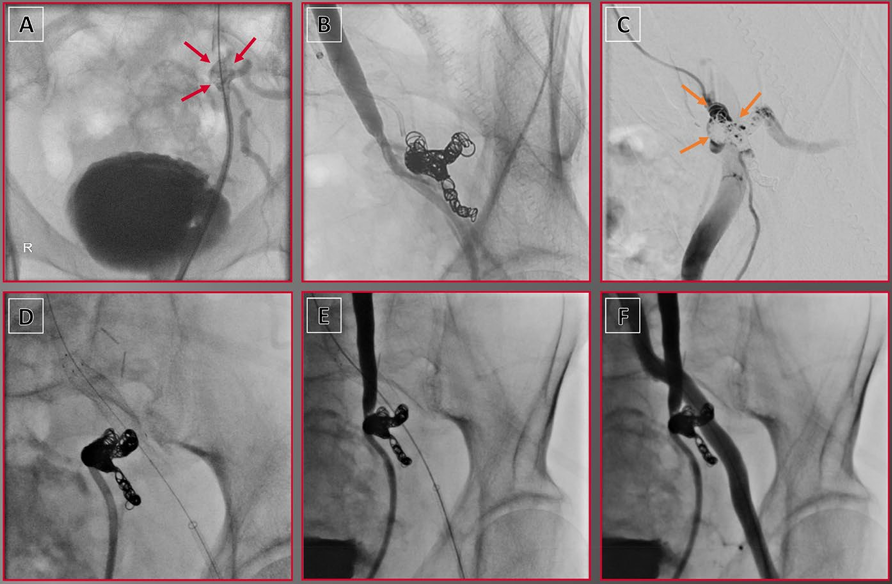 动脉钳怎么用动脉重度钙化导丝无法通过 针具技术超补救策略_https://www.jmylbn.com_新闻资讯_第26张