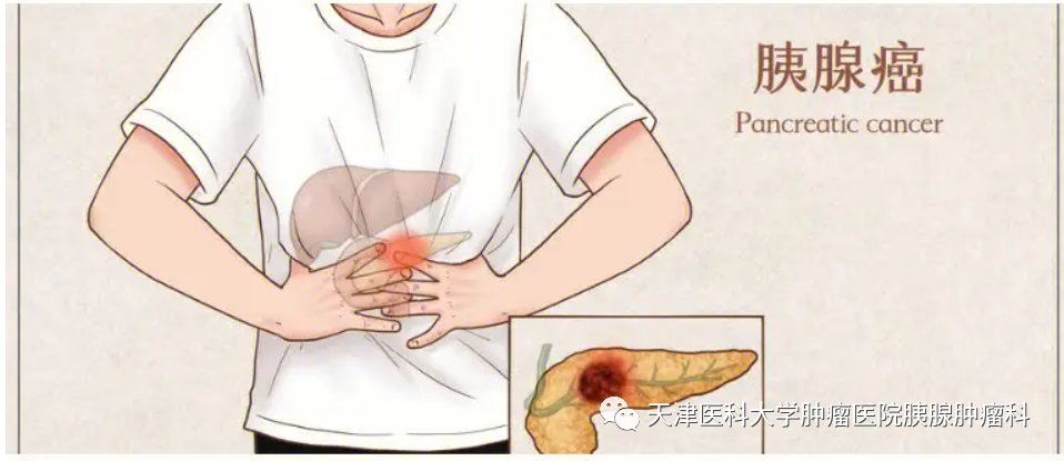 胰腺癌与不良饮食习惯的关系