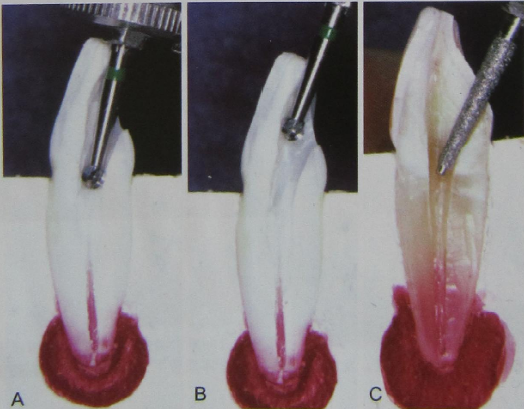 开髓必须掌握的八个要点​