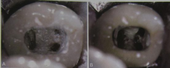 开髓必须掌握的八个要点​