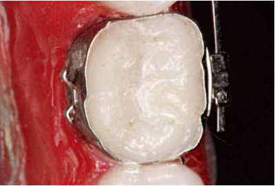 口腔颊面管怎么放置准确安装矫治器+临床注意事项，你get了没_https://www.jmylbn.com_新闻资讯_第9张