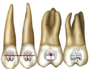 口腔颊面管怎么放置准确安装矫治器+临床注意事项，你get了没_https://www.jmylbn.com_新闻资讯_第4张