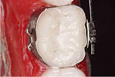口腔颊面管怎么放置准确安装矫治器+临床注意事项，你get了没_https://www.jmylbn.com_新闻资讯_第8张
