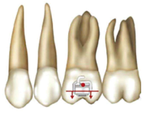 口腔颊面管怎么放置准确安装矫治器+临床注意事项，你get了没_https://www.jmylbn.com_新闻资讯_第10张