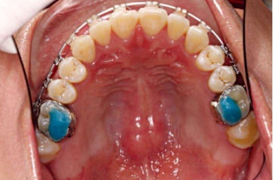 口腔颊面管怎么放置准确安装矫治器+临床注意事项，你get了没_https://www.jmylbn.com_新闻资讯_第12张