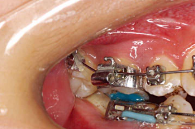 口腔颊面管怎么放置准确安装矫治器+临床注意事项，你get了没_https://www.jmylbn.com_新闻资讯_第7张