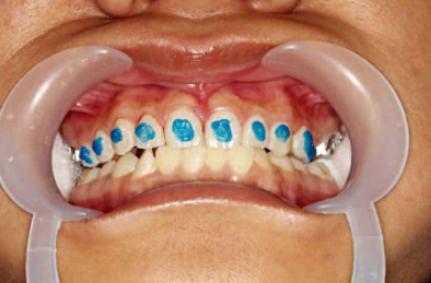 口腔颊面管怎么放置准确安装矫治器+临床注意事项，你get了没_https://www.jmylbn.com_新闻资讯_第13张