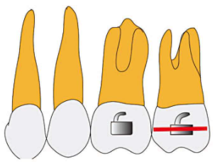 口腔颊面管怎么放置准确安装矫治器+临床注意事项，你get了没_https://www.jmylbn.com_新闻资讯_第11张