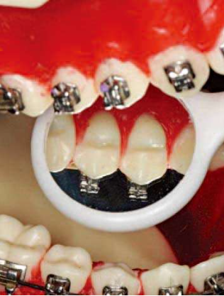 口腔颊面管怎么放置准确安装矫治器+临床注意事项，你get了没_https://www.jmylbn.com_新闻资讯_第2张