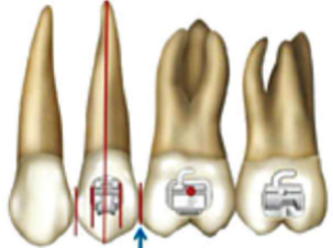 口腔颊面管怎么放置准确安装矫治器+临床注意事项，你get了没_https://www.jmylbn.com_新闻资讯_第3张