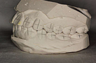 口腔颊面管怎么放置准确安装矫治器+临床注意事项，你get了没_https://www.jmylbn.com_新闻资讯_第1张