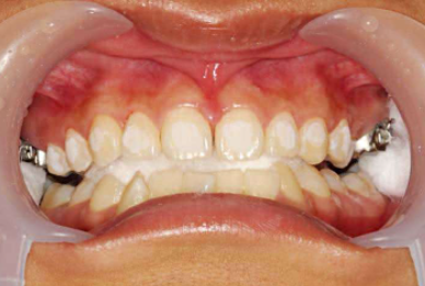 口腔颊面管怎么放置准确安装矫治器+临床注意事项，你get了没_https://www.jmylbn.com_新闻资讯_第14张