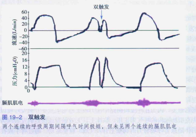 为什么呼吸机人机同步人机不同步与呼吸机波形分析，处理方式如下_https://www.jmylbn.com_新闻资讯_第3张
