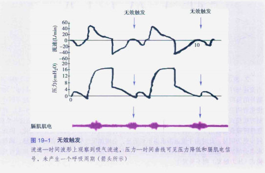 为什么呼吸机人机同步人机不同步与呼吸机波形分析，处理方式如下_https://www.jmylbn.com_新闻资讯_第2张