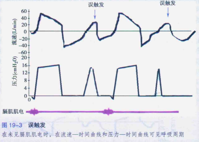 为什么呼吸机人机同步人机不同步与呼吸机波形分析，处理方式如下_https://www.jmylbn.com_新闻资讯_第4张
