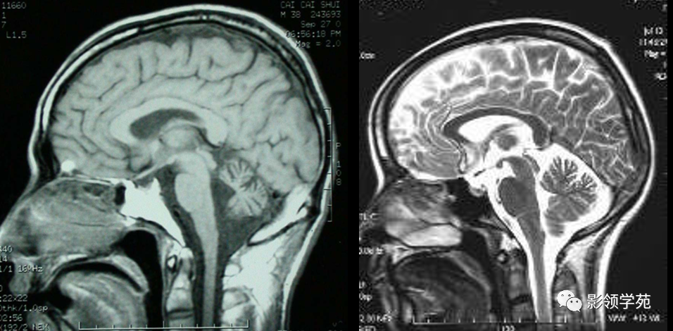 ▌ 正常mri表現▌ 正常ct表現延髓向下經枕骨大孔與脊髓相連.