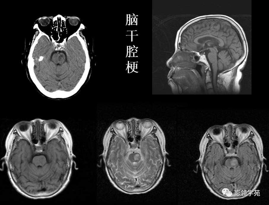 10种脑干区常见病变影像表现,一文总结_医学界-助力医生临床决策和