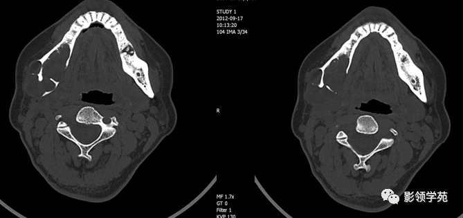 颌骨常见囊性病变的ct诊断 | 最全总结_医学界-助力医生临床决策和