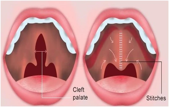 2-4岁,作语音评估和腭咽闭合测定,必要时需要做腭咽成形手术;4.