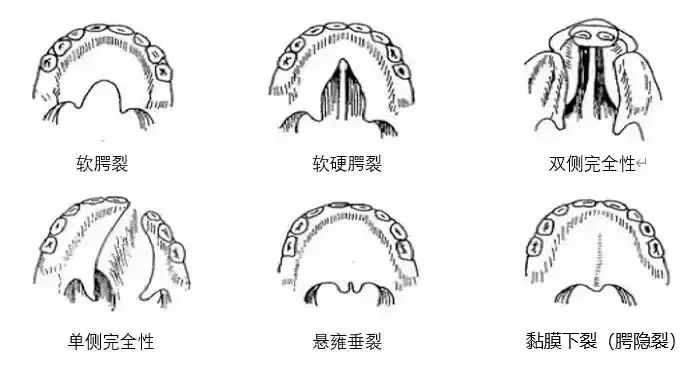 唇腭裂是我国最常见的先天畸形,是生活中大家常说的"兔唇"或"狼咽"