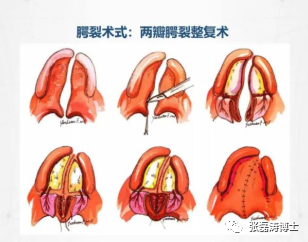 唇腭裂修复手术什么时候做最合适?