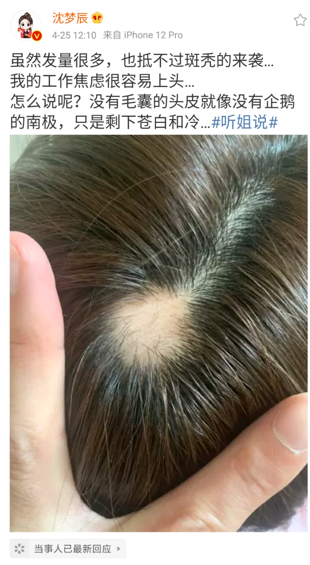 沈梦辰都逃不掉的斑秃，应对方法都在这里了！