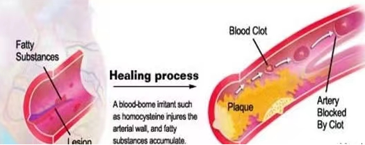同型半氨酸怎么化验认识同型半胱氨酸（Hcy）！_https://www.jmylbn.com_新闻资讯_第5张