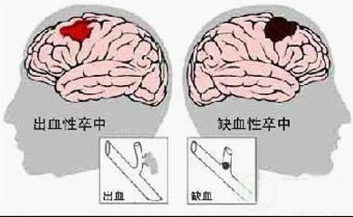 同型半氨酸怎么化验认识同型半胱氨酸（Hcy）！_https://www.jmylbn.com_新闻资讯_第4张