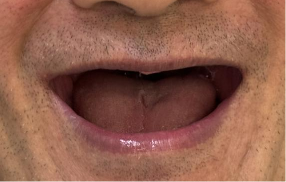 口腔吸盘怎么安装像“吸盘”一样的吸附性义齿——无牙颌的福音!_https://www.jmylbn.com_新闻资讯_第5张