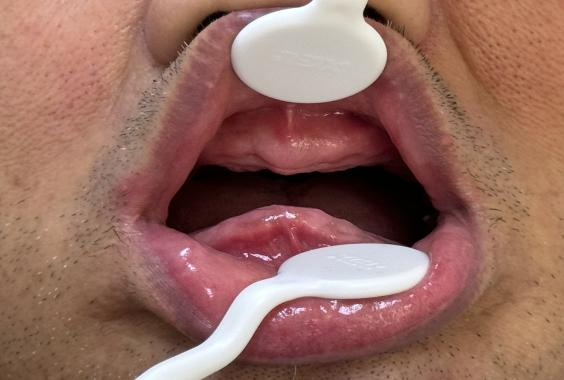 口腔吸盘怎么安装像“吸盘”一样的吸附性义齿——无牙颌的福音!_https://www.jmylbn.com_新闻资讯_第4张