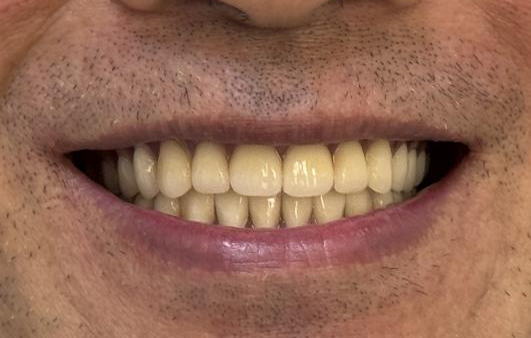 口腔吸盘怎么安装像“吸盘”一样的吸附性义齿——无牙颌的福音!_https://www.jmylbn.com_新闻资讯_第6张