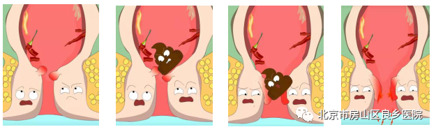 pph吻合器怎么使用普外科“痔”微创治疗系列科普（三）吻合器痔上黏膜环切术（PPH）_https://www.jmylbn.com_新闻资讯_第2张