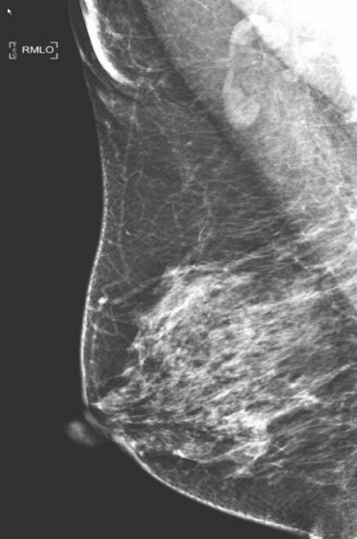 数字钼靶是什么【医讯】数字化乳腺钼靶（乳腺DR）——乳腺癌的照妖镜_https://www.jmylbn.com_新闻资讯_第13张