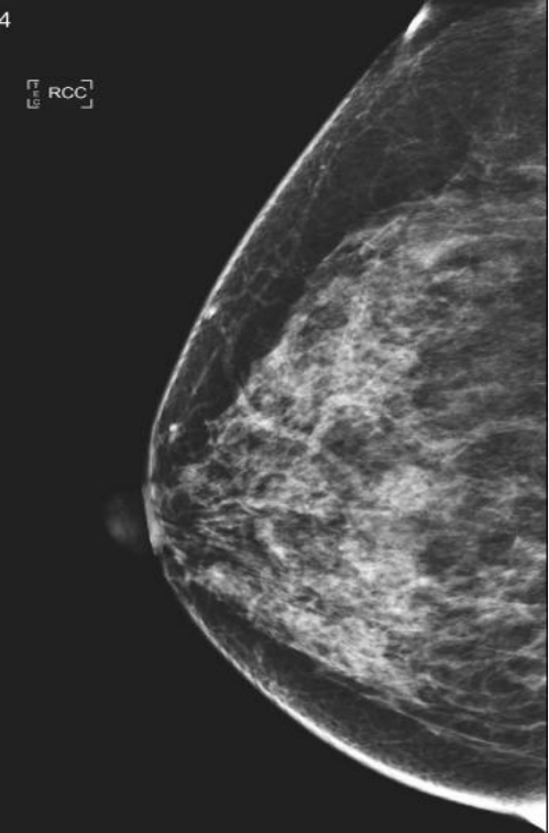 数字钼靶是什么【医讯】数字化乳腺钼靶（乳腺DR）——乳腺癌的照妖镜_https://www.jmylbn.com_新闻资讯_第12张