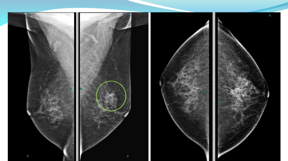 数字钼靶是什么【医讯】数字化乳腺钼靶（乳腺DR）——乳腺癌的照妖镜_https://www.jmylbn.com_新闻资讯_第7张