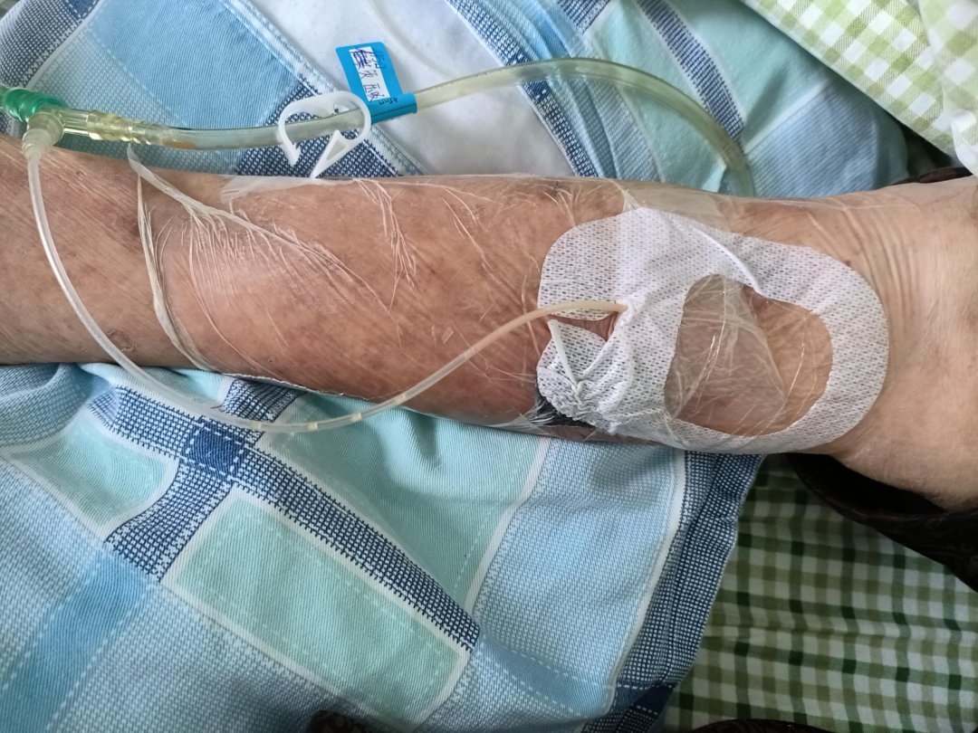 为什么负压引流负压封闭引流技术（VSD）护理慢性难愈创面_https://www.jmylbn.com_新闻资讯_第7张