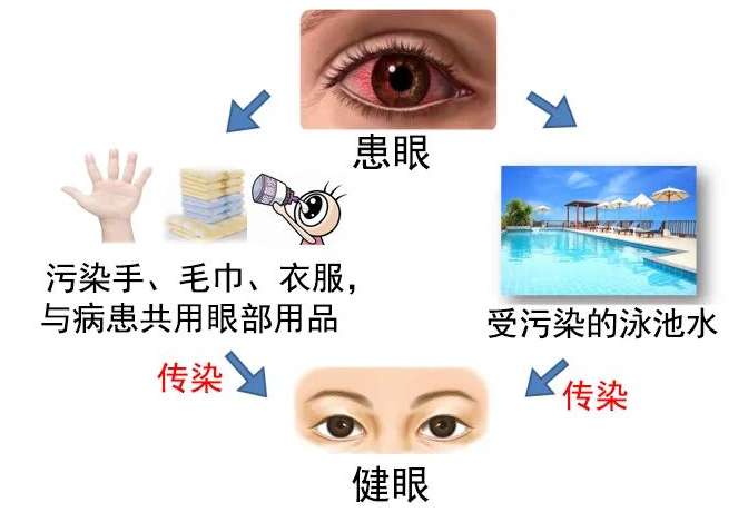 红眼病图片 传染途径图片