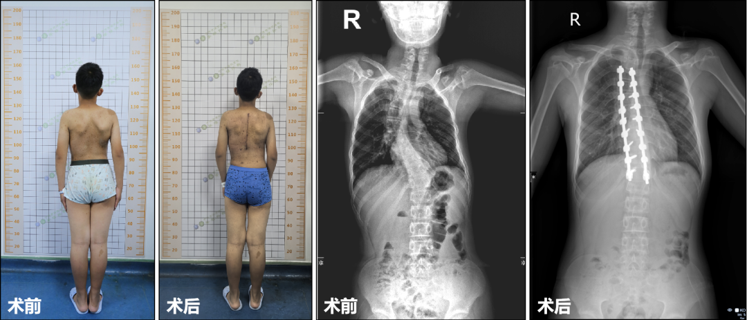 術(shù)前術(shù)后對(duì)比