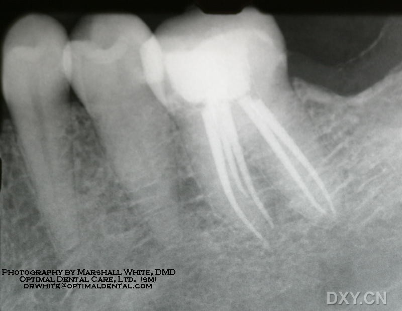 根管马达怎么修【新技术 新项目】第922医院2021—2022年34项新技术、新项目之十九：医生好助手 根管马达在根管治疗中的应用（口腔科）_https://www.jmylbn.com_新闻资讯_第9张