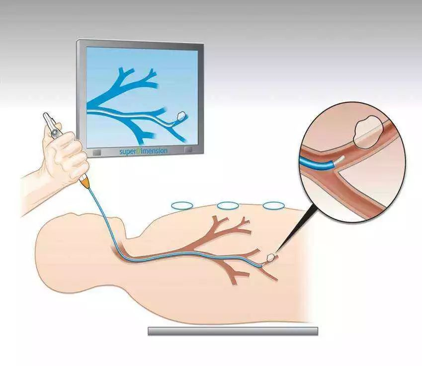 纤支镜什么品牌好什么是纤支镜？哪些患者需要做纤支镜检查？_https://www.jmylbn.com_新闻资讯_第5张