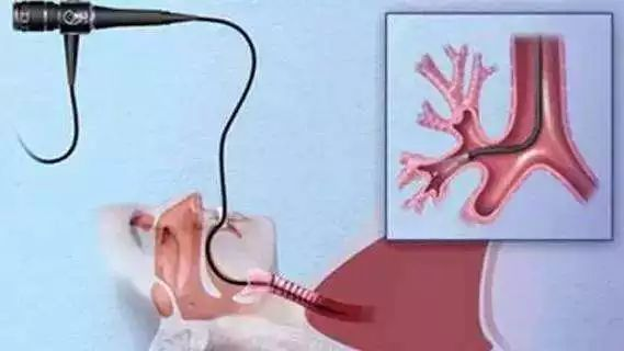 纤支镜什么品牌好什么是纤支镜？哪些患者需要做纤支镜检查？_https://www.jmylbn.com_新闻资讯_第11张