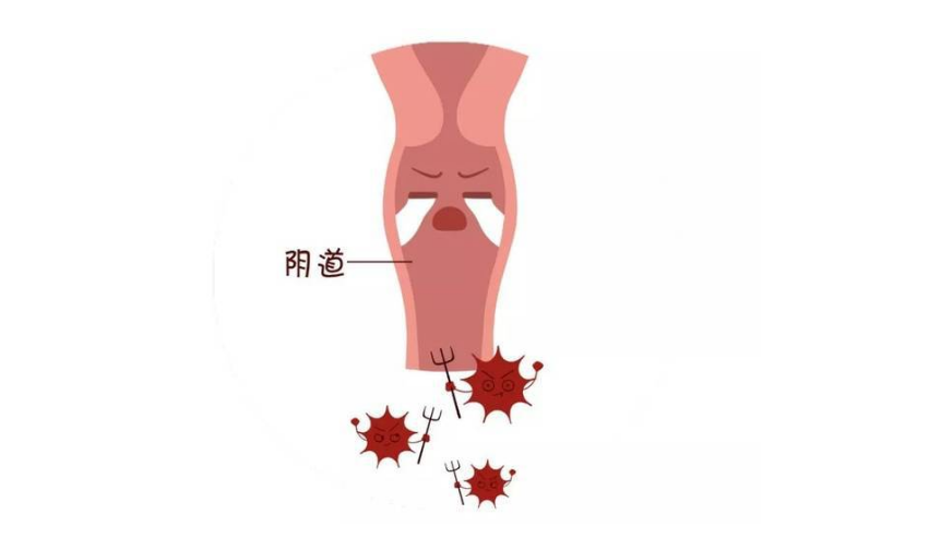 妇科流体敷料怎么用霉菌性阴道炎反复发作，久治不愈怎么办？锦露®妇科流体敷料调节阴道微生态，降低炎症复发！_https://www.jmylbn.com_新闻资讯_第6张