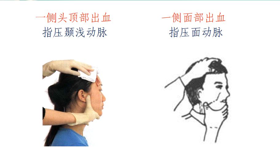 止血环什么样子干货！创伤救护--止血、包扎图解-上海聚慕医疗器械有限公司