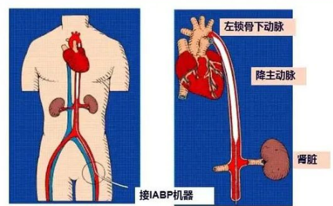 动脉泵是什么【“医”说就懂】ICU的救命利器——IABP（主动脉内球囊反搏泵）-上海聚慕医疗器械有限公司