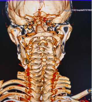 术前ct测量椎弓根宽度术前ct评估骨折2021年8月6日,手术如期进行,骨科