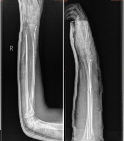 钛针是什么材料儿童骨折不用慌，小小钛针来帮忙！_https://www.jmylbn.com_新闻资讯_第5张