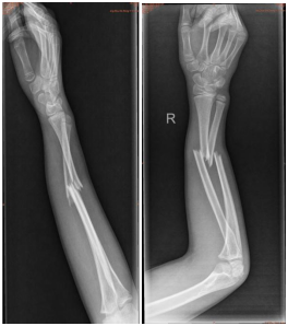 钛针是什么材料儿童骨折不用慌，小小钛针来帮忙！_https://www.jmylbn.com_新闻资讯_第4张