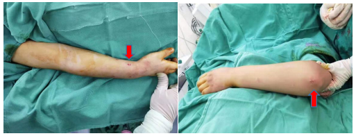 钛针是什么材料儿童骨折不用慌，小小钛针来帮忙！_https://www.jmylbn.com_新闻资讯_第6张